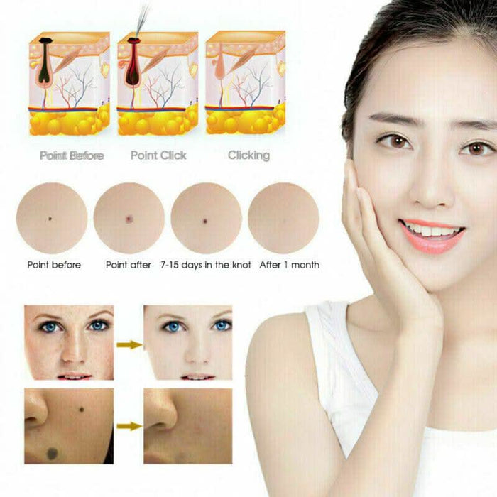 Mole Removal Pen Portable Skin Tag Repair Kit Face Care Skin Removal Freckle Wart dark Spot Remover - Battery Mate